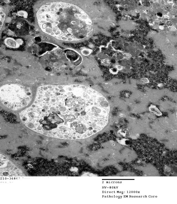 2C5A Autophagic Myopathy (Case 2)_021 - Copy