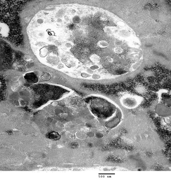 2C5B Autophagic Myopathy (Case 2)_022 - Copy