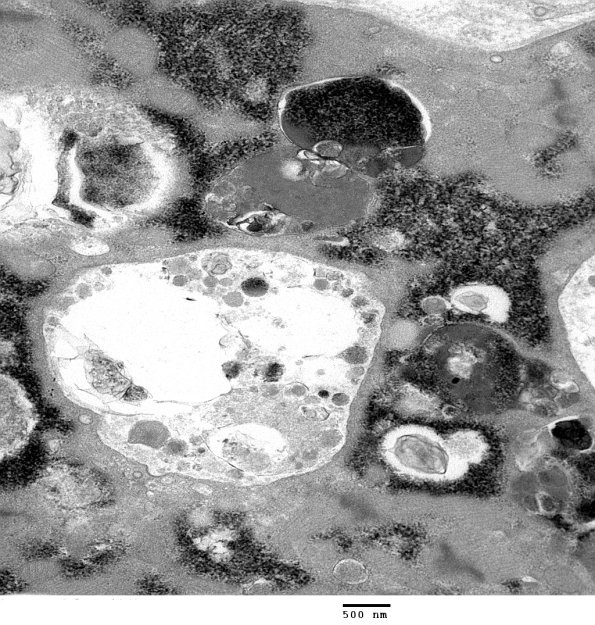 2C5C Autophagic Myopathy (Case 2)_023 - Copy