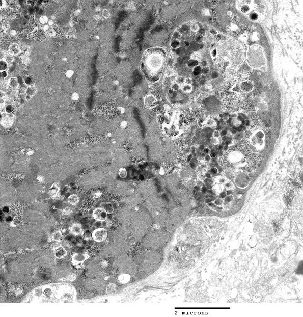 2C6A Autophagic Myopathy (Case 2)_037 - Copy