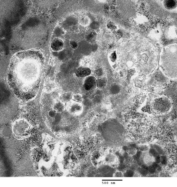 2C6B Autophagic Myopathy (Case 2)_038 - Copy
