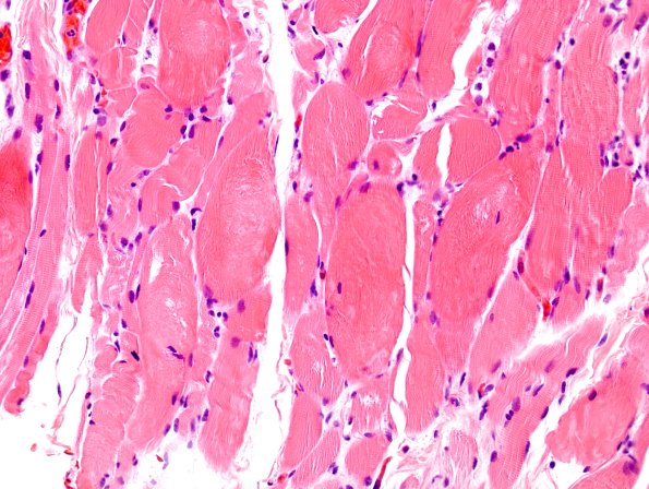 3A1 Autophagic Myopathy (Case 3) H&E 1