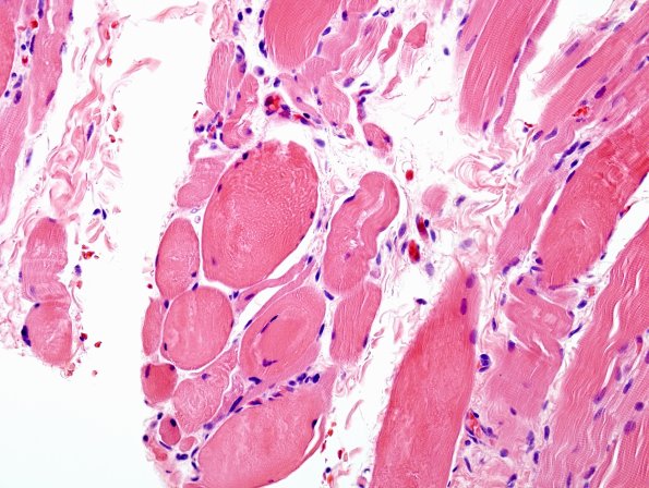 3A2 Autophagic Myopathy (Case 3) H&E 2