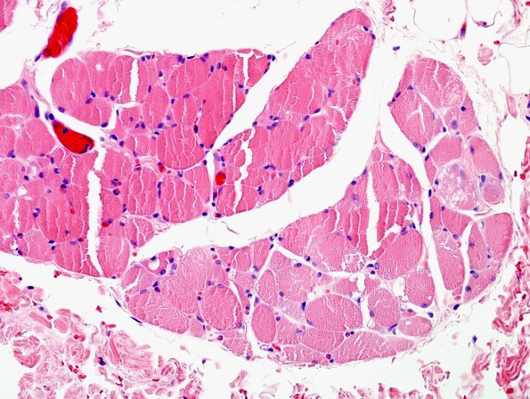 3A3 Autophagic Myopathy (Case 3) H&E 5