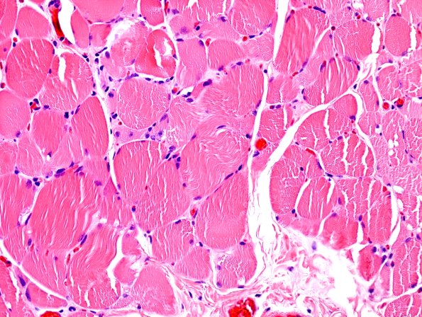 3A4 Autophagic Myopathy (Case 3) H&E 3