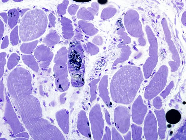 3B1A Autophagic Myopathy (Case 3) Plastic 4