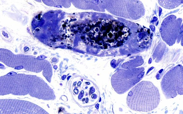 3B1B Autophagic Myopathy (Case 3) Plastic 100X 1