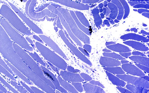 3B2A Autophagic Myopathy (Case 3) Plastic 20X