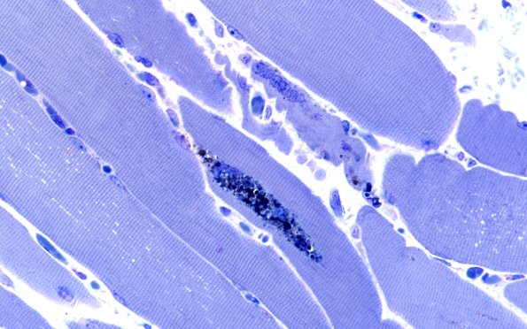 3B2B Autophagic Myopathy (Case 3) Plastic 60X