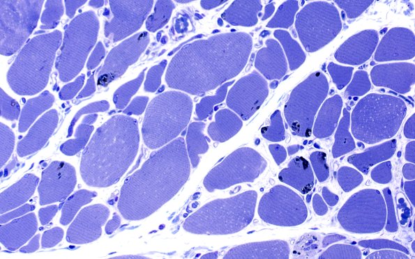 3B3A Autophagic Myopathy (Case 3) Plastic 40X 1