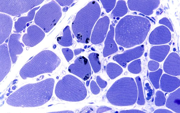 3B3B Autophagic Myopathy (Case 3) Plastic 60X 1