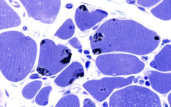 3B3C Autophagic Myopathy (Case 3) Plastic 100X 2