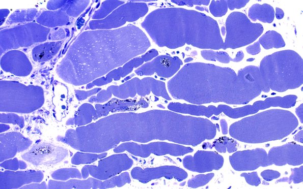 3B4A Autophagic Myopathy (Case 3) Plastic 40X 3
