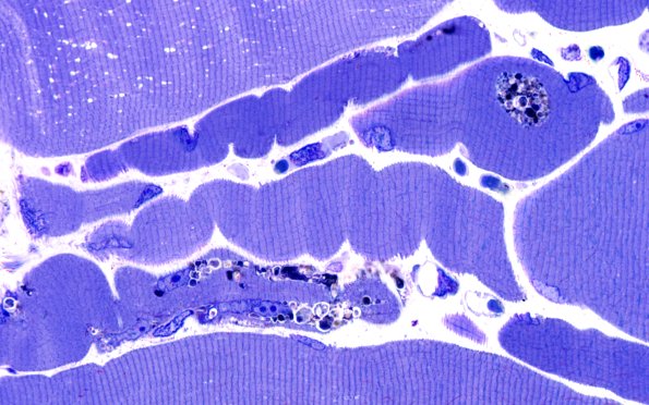 3B4B Autophagic Myopathy (Case 3) Plastic 100X 3
