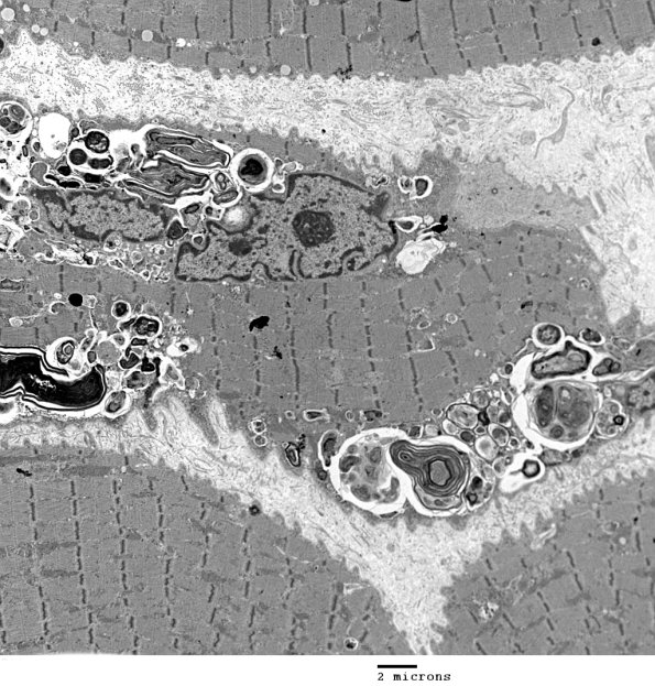 3C10A Autophagic Myopathy (Case 3) EM 028 - Copy