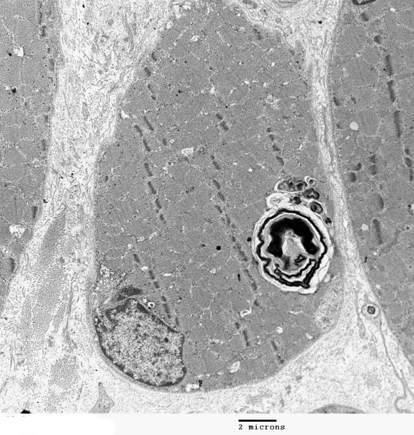 3C1A Autophagic Myopathy (Case 3) EM 005 - Copy