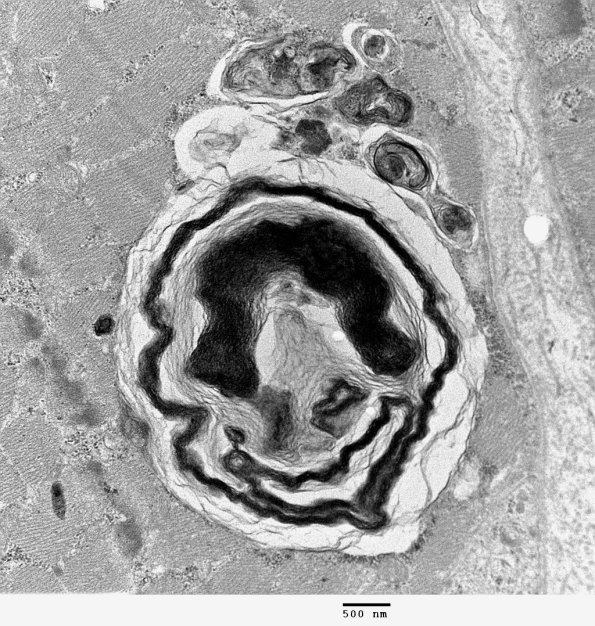 3C1B Autophagic Myopathy (Case 3) EM 006 - Copy