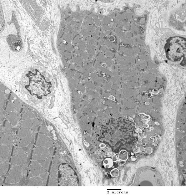 3C2A Autophagic Myopathy (Case 3) EM 021 - Copy