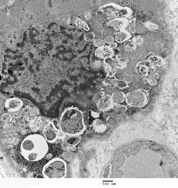 3C2B Autophagic Myopathy (Case 3) EM 022 - Copy