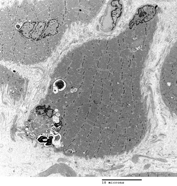 3C3Autophagic Myopathy (Case 3) EM 008 - Copy