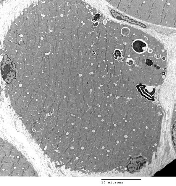 3C4 Autophagic Myopathy (Case 3) EM 013 - Copy