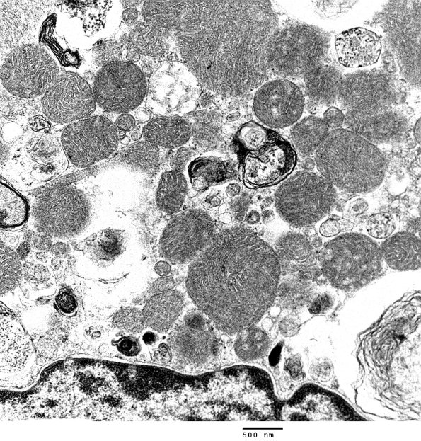 3C5 Autophagic Myopathy (Case 3) EM 012 - Copy