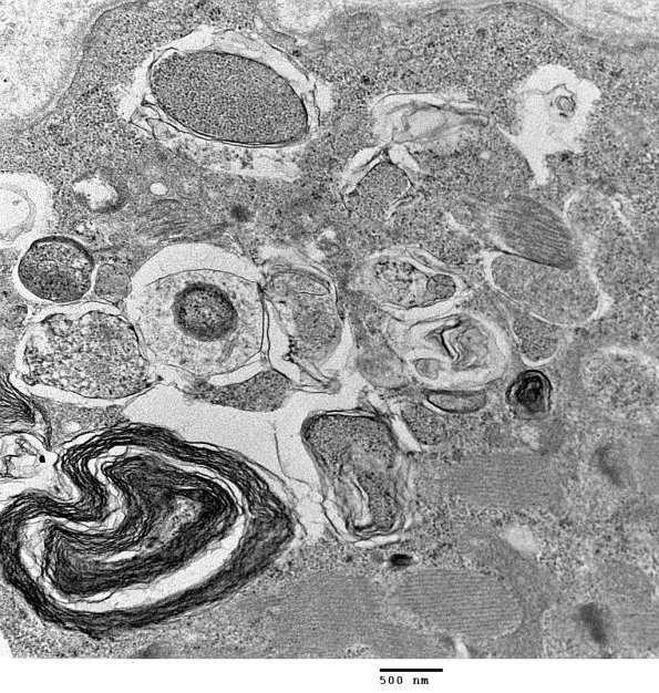 3C6 Autophagic Myopathy (Case 3) EM 007 - Copy