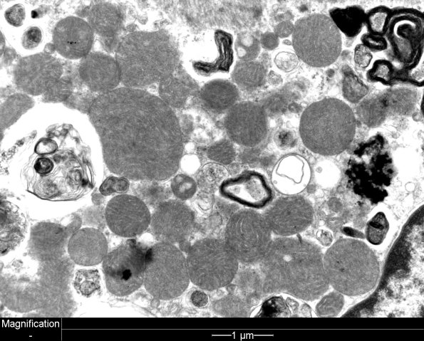 3C7A Autophagic Myopathy (Case 3) EM 16 - Copy