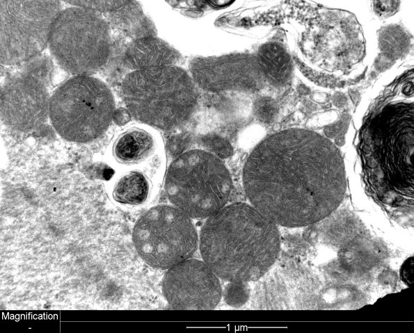 3C7B Autophagic Myopathy (Case 3) EM 17 - Copy