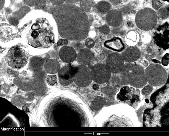 3C7C Autophagic Myopathy (Case 3) EM 18 - Copy