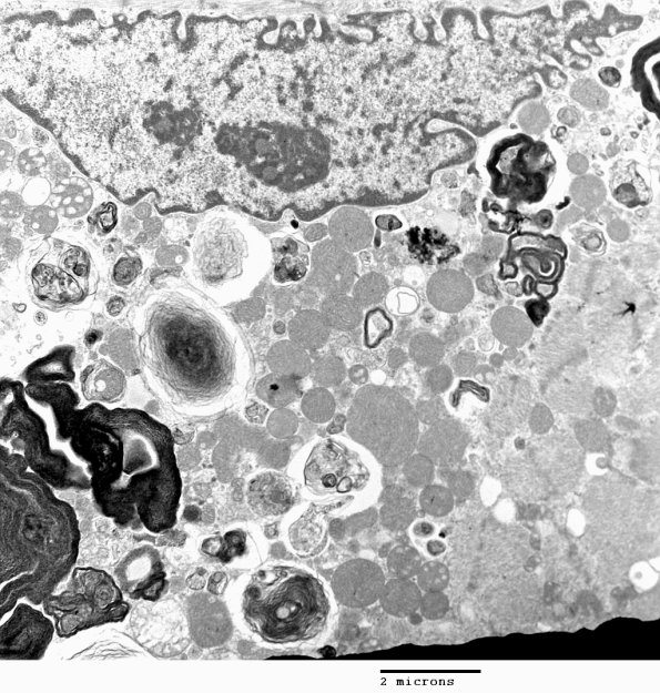 3C8A Autophagic Myopathy (Case 3) EM 026 - Copy