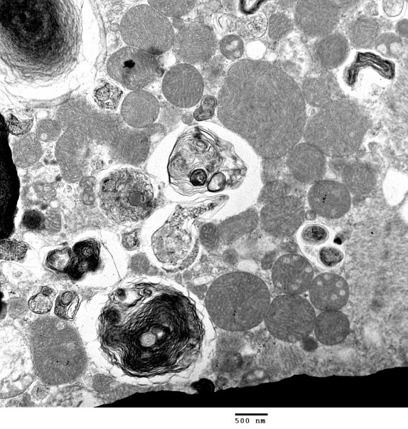 3C8B Autophagic Myopathy (Case 3) EM 027 - Copy