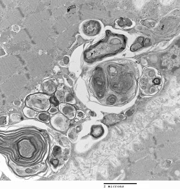 3C8C Autophagic Myopathy (Case 3) EM 030 - Copy