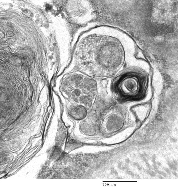3C8D Autophagic Myopathy (Case 3) EM 031 - Copy
