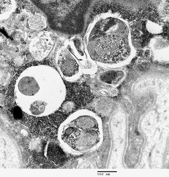 3C9A Autophagic Myopathy (Case 3) EM 023 - Copy