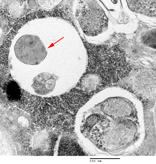 3C9BAutophagic Myopathy (Case 3) EM 024 - Copy copy