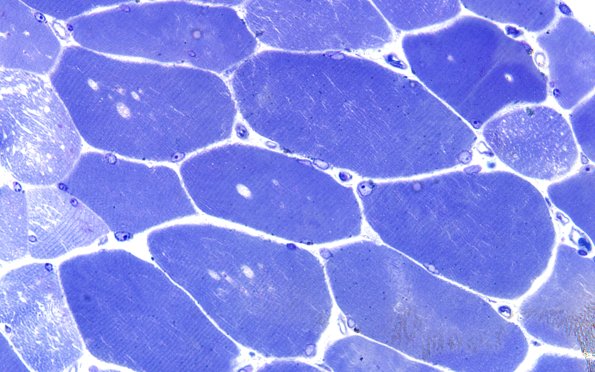 4A1A (Case 4) Muscle 60X 3