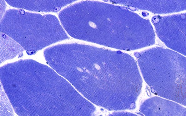 4A1B (Case 4) Muscle 100X 2