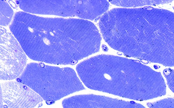 4A1C (Case 4) Muscle 100X 3