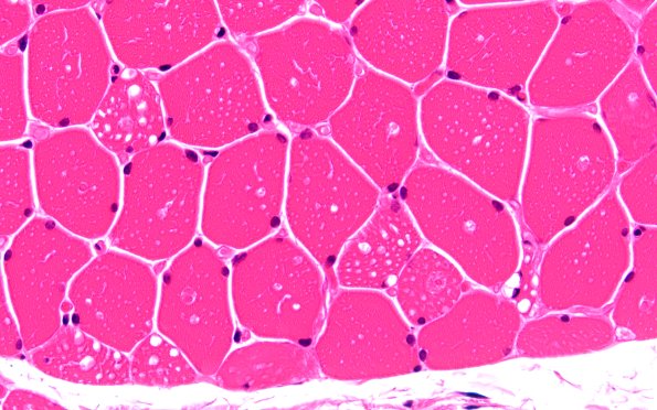 5A1C (Case 5) H&E 60X