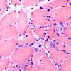 7F1 (Case 7) CongoRed 40X