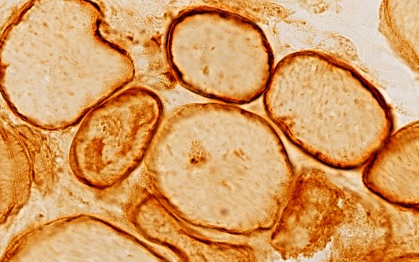 7K2C (Case 7) Caveolin 100X 1