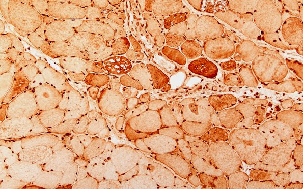 7M1 (Case 7) FK2-Ubiquitin 20X 2
