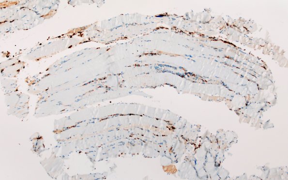 7Q1 (Case 7) T muscle CD68 10X