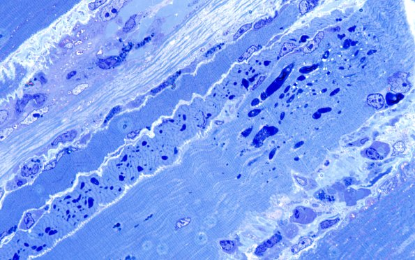 7R3 (Case 7) T muscle Plastic 100X 10
