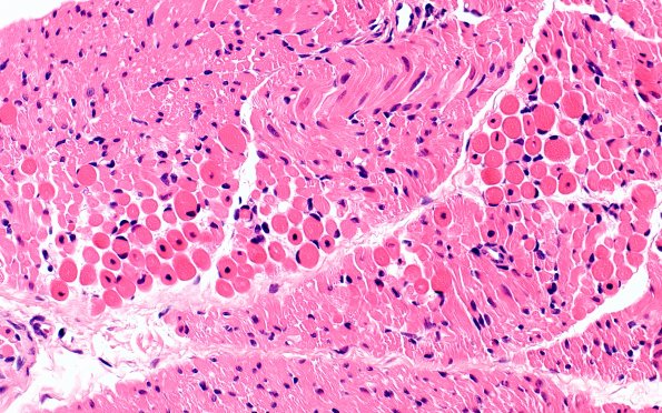 1A2 Centronuclear myopathy (Case 1) H&E 1