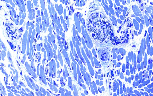 1B1 Centronuclear myopathy (Case 1) Plastic 1