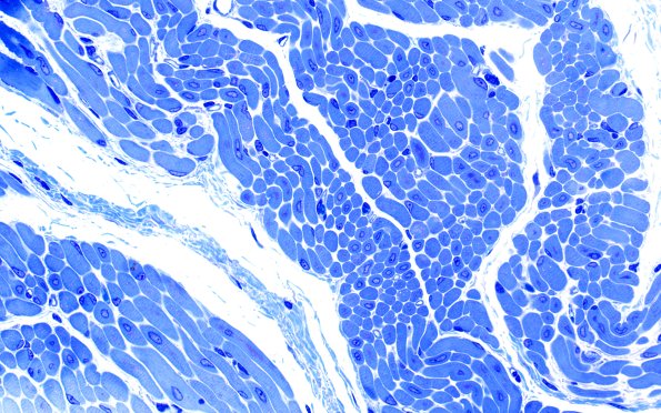 1B4A Centronuclear myopathy (Case 1) Plastic 3