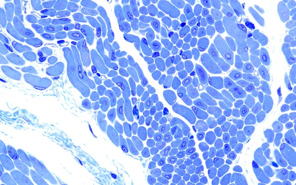 1B4B Centronuclear myopathy (Case 1) Plastic 2