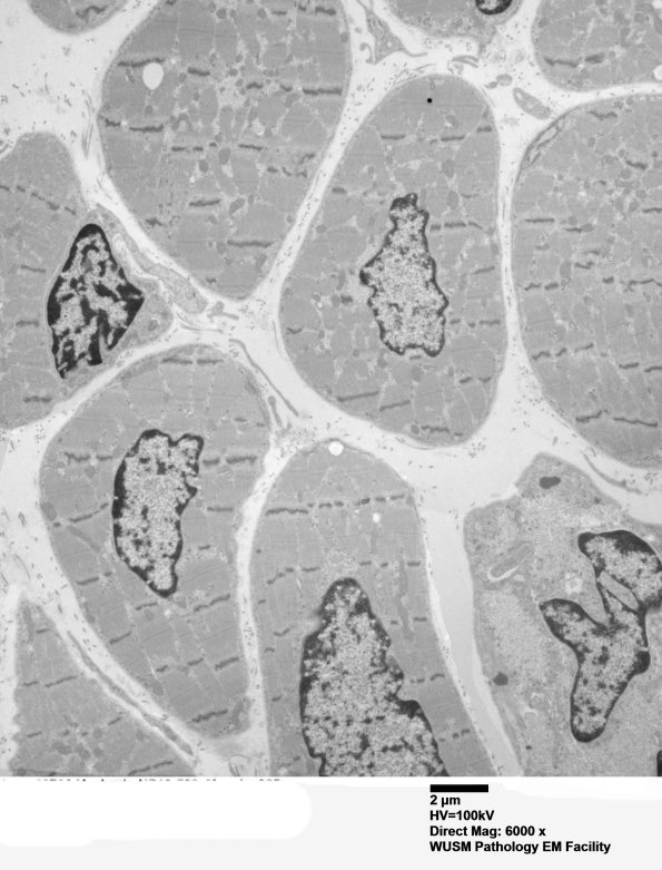 1C1A Centronuclear Myopathy (Case 1) EM 025 - Copy